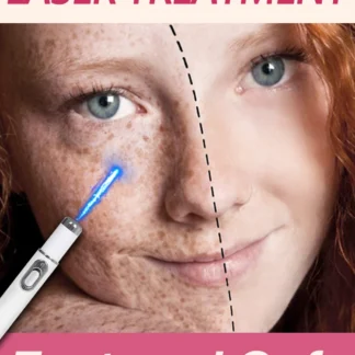 Las manchas faciales Nano láser se han ido