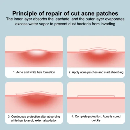 1 Juego de vendaje hidrocoloide impermeable extrafino: vendaje bordeado desechable suave para el cuidado de heridas